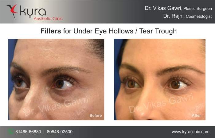 under eye fillers kyra clinic
