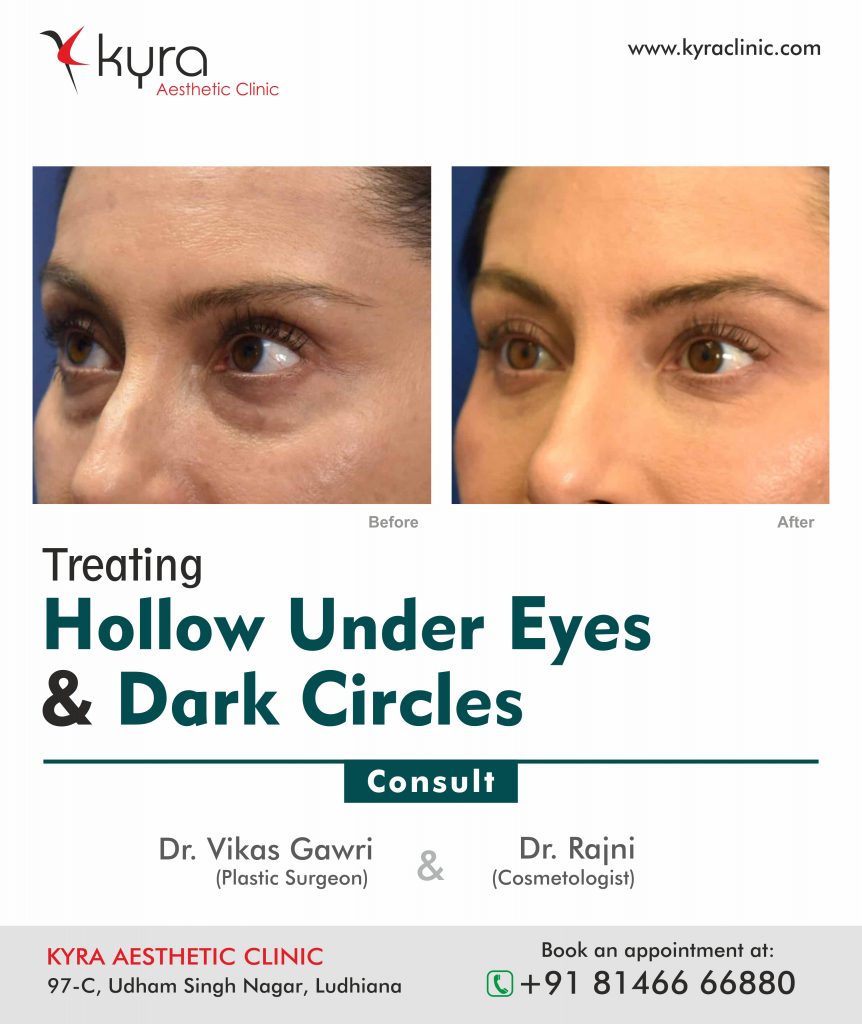 Under Eye Hollows & Tear Trough - Cosmetic Surgery in Ludhiana, Plastic  Surgery in Punjab, Laser and Cosmetic Surgeon in Ludhiana, Punjab, India