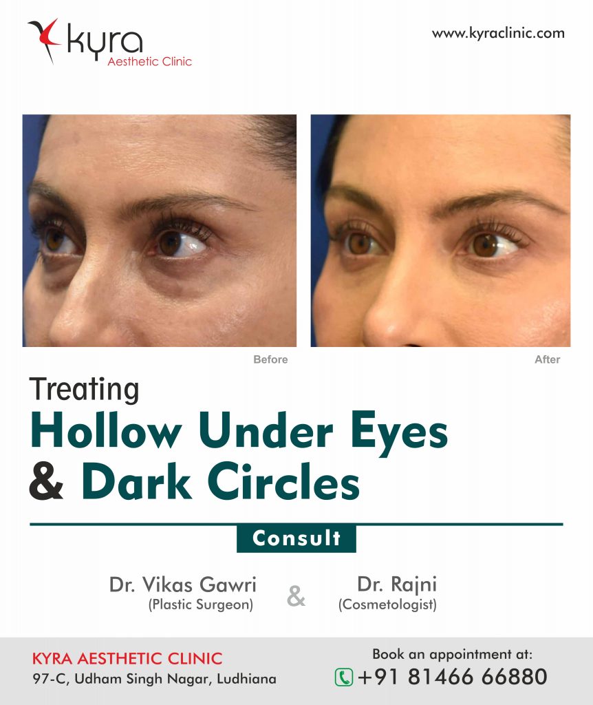 Under Eye Hollows & Tear Trough - Cosmetic Surgery in Ludhiana, Plastic Surgery in Punjab, Laser and Cosmetic Surgeon in Ludhiana, Punjab, India Under Eye Hollows & Tear Trough - Cosmetic Surgery in Ludhiana, Plastic Surgery in Punjab, Laser and Cosmetic Surgeon in Ludhiana, Punjab, India