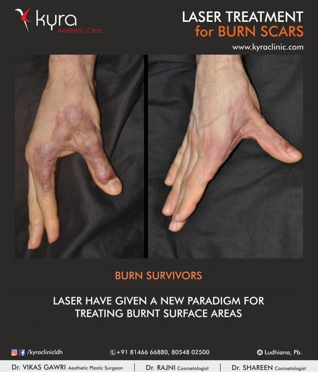 Laser Teratment for Burn Scars 2 laser burn scar hands