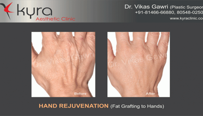 before-and-after-fat-transfer-to-hands-kyra before-and-after-fat-transfer-to-hands-kyra