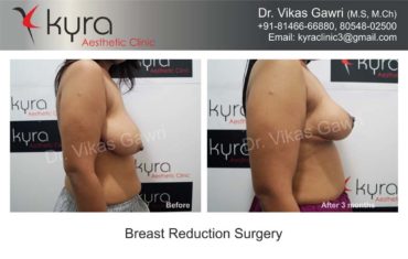 breast-implants-in-punjab21