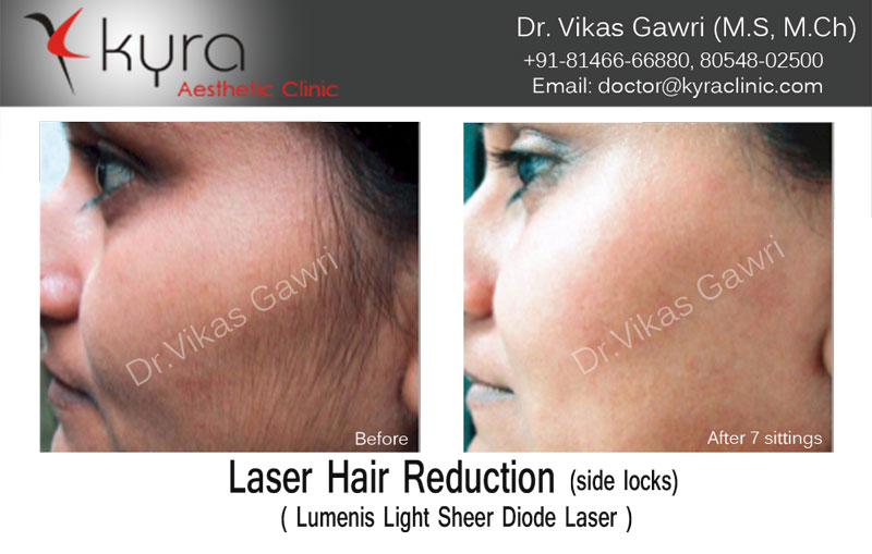 Laser Hair Removal in Ludhiana | Laser Hair Removal Cost Ludhiana Laser Hair Removal in Ludhiana | Laser Hair Removal Cost Ludhiana