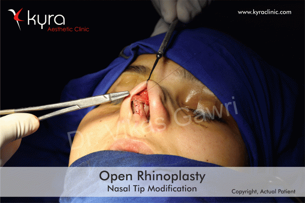 rhinoplasty-2 rhinoplasty-2