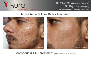 Active Acne & Acne Scars Treatment 2