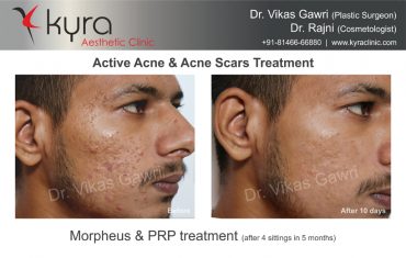 Active Acne & Acne Scars Treatment 3