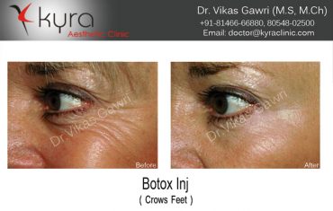 botox-1