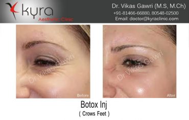 botox-2
