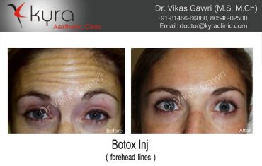 botox-3