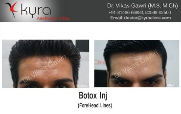 botox-5