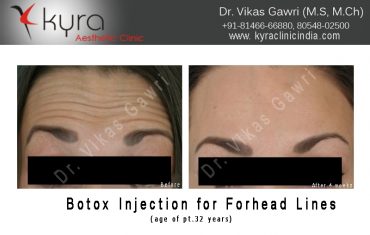 botox-6