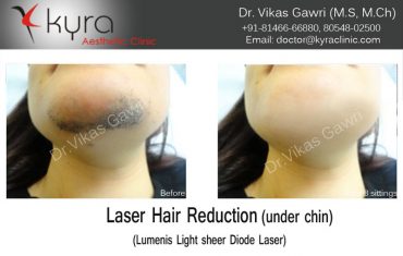 hair-removal-1