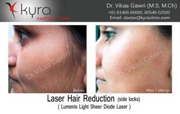 hair-removal-2
