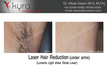 hair-removal-3