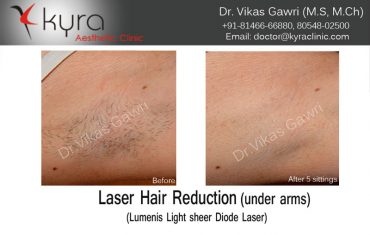 hair-removal-4
