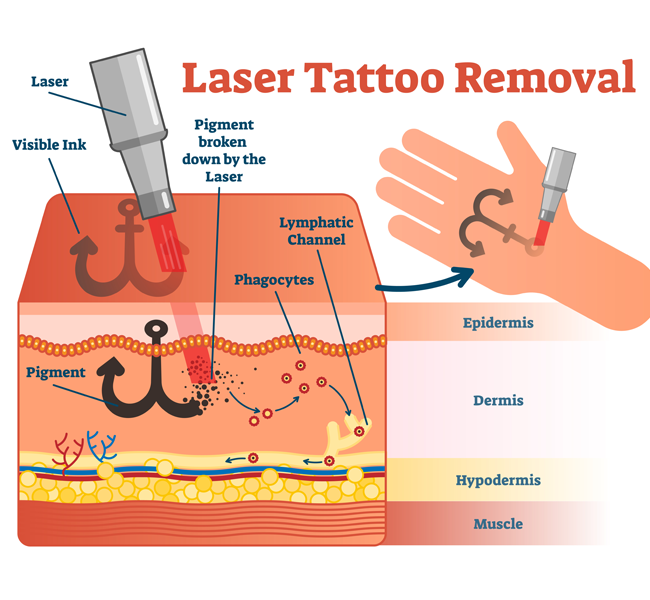 Cost of Tattoo Removal  Millefiori