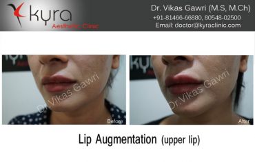 lip-enhancement-12