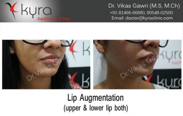 lip-enhancement-15