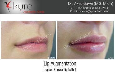 lip-enhancement-16