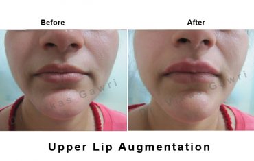 lip-enhancement-3