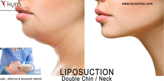 liposuction-doublechin liposuction-doublechin