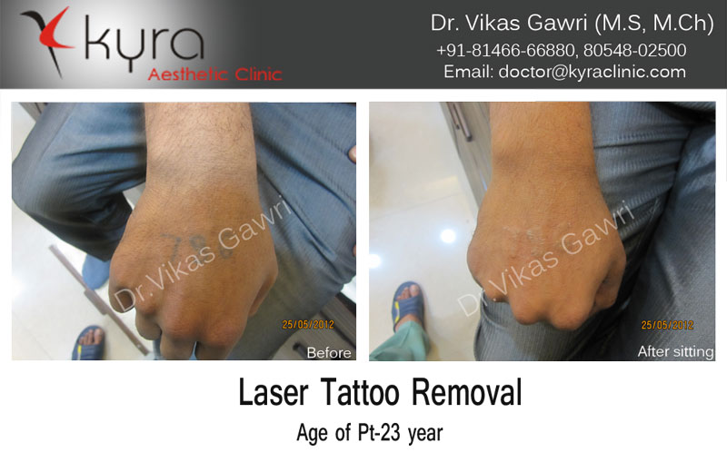 Laser Tattoo Removal with PicoSure Laser Treatment  Epilium  Skin