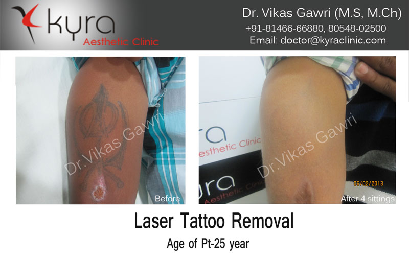 Laser Tattoo Removal Before  After Photos  Allergy  Skin Spa