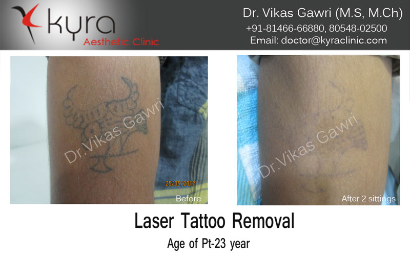 Laser Tatoo Removal  Dr Rai SkinVDLeprosy Clinic