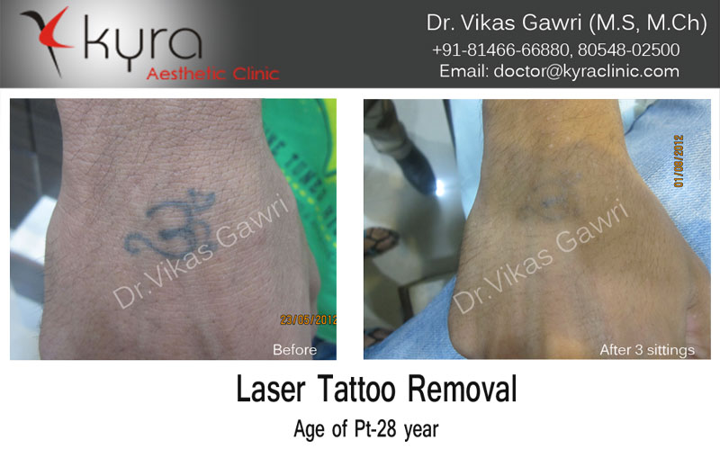 Laser Tattoo Removal in West Bloomfield  Affordable  Chroma Tattoo