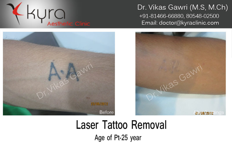 Best Laser Tattoo Removal Center In SaharanpurChandra skin care