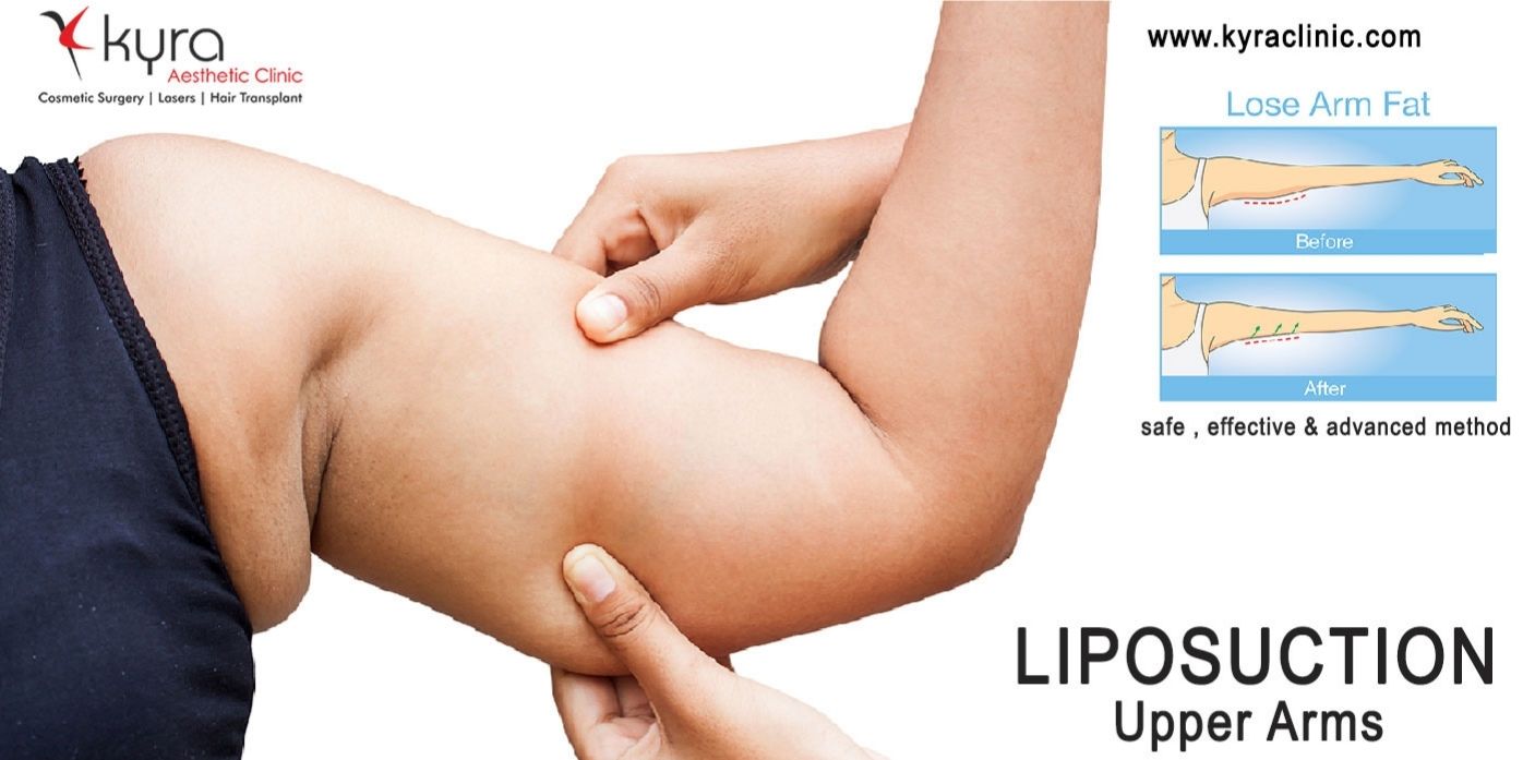 vaser-liposuction-arms