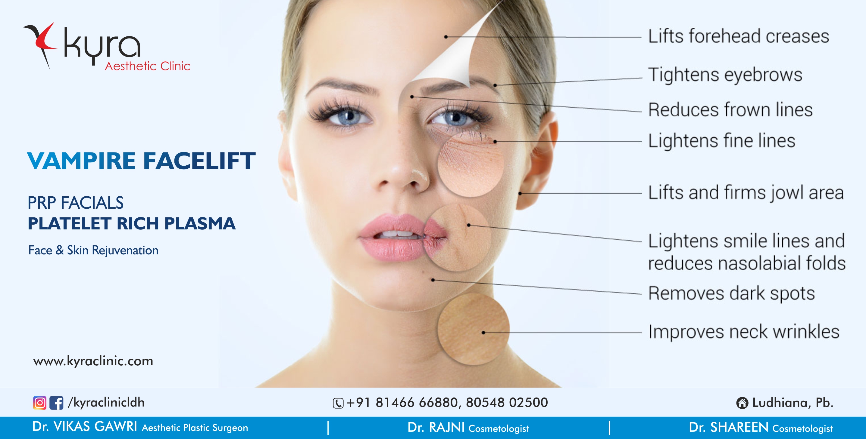 vampire face lift kyra clinic
