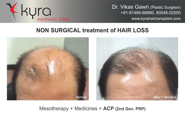 prp for hair loss kyraclinic