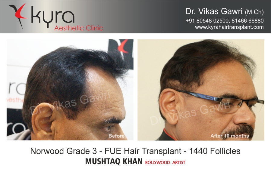 Hair transplant in Dera Ghazi Khan  Specialist Free hair loss Advice