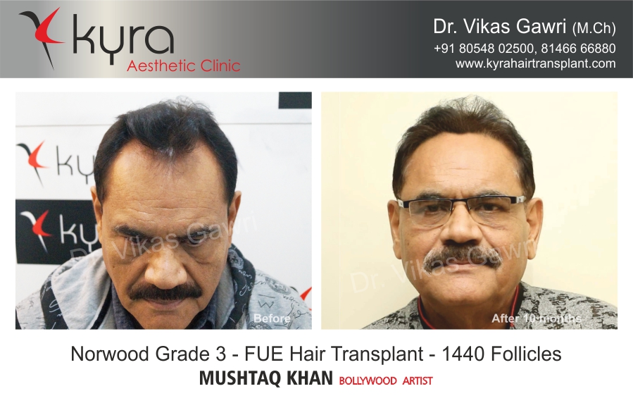 Hair Transplant: Before - After Gallery - Cosmetic Surgery in Ludhiana, Plastic Surgery in Punjab, Laser and Cosmetic Surgeon in Ludhiana, Punjab, India Hair Transplant: Before - After Gallery - Cosmetic Surgery in Ludhiana, Plastic Surgery in Punjab, Laser and Cosmetic Surgeon in Ludhiana, Punjab, India