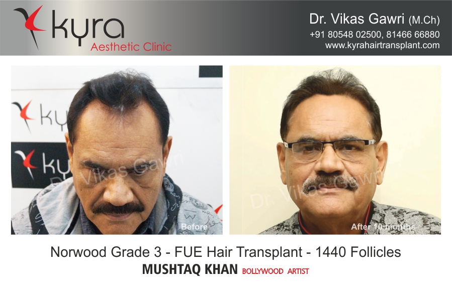 Best Hair Transplant In Ludhiana  Health Beauty  Fitness Service In  Aggar Nagar Ludhiana  Clickin