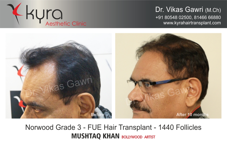 Hair Transplant: Before - After Gallery - Cosmetic Surgery in Ludhiana, Plastic Surgery in Punjab, Laser and Cosmetic Surgeon in Ludhiana, Punjab, India Hair Transplant: Before - After Gallery - Cosmetic Surgery in Ludhiana, Plastic Surgery in Punjab, Laser and Cosmetic Surgeon in Ludhiana, Punjab, India