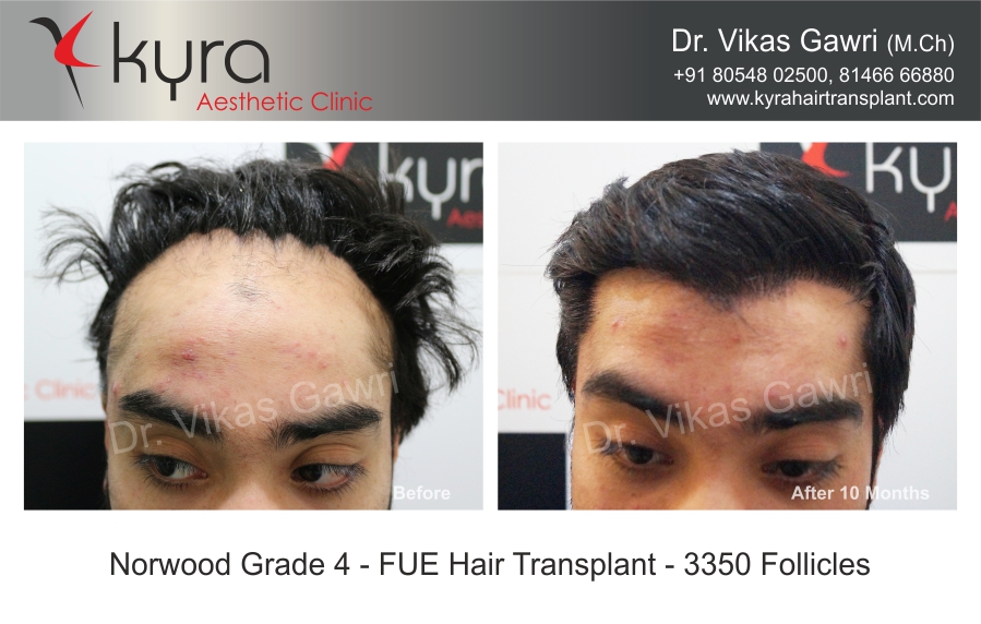 Hair Transplant: Before - After Gallery - Cosmetic Surgery in Ludhiana,  Plastic Surgery in Punjab, Laser and Cosmetic Surgeon in Ludhiana, Punjab,  India