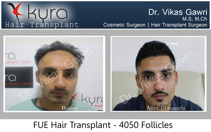 Hair Transplant Punjab India Hair Transplant Cost in Punjab