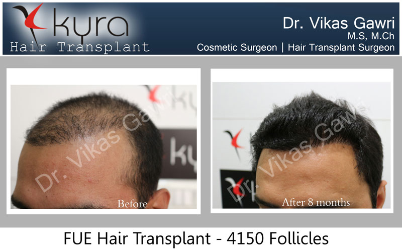 Hair Transplant Archives - Cosmetic Surgery in Ludhiana, Plastic Surgery in Punjab, Laser and Cosmetic Surgeon in Ludhiana, Punjab, India Hair Transplant Archives - Cosmetic Surgery in Ludhiana, Plastic Surgery in Punjab, Laser and Cosmetic Surgeon in Ludhiana, Punjab, India