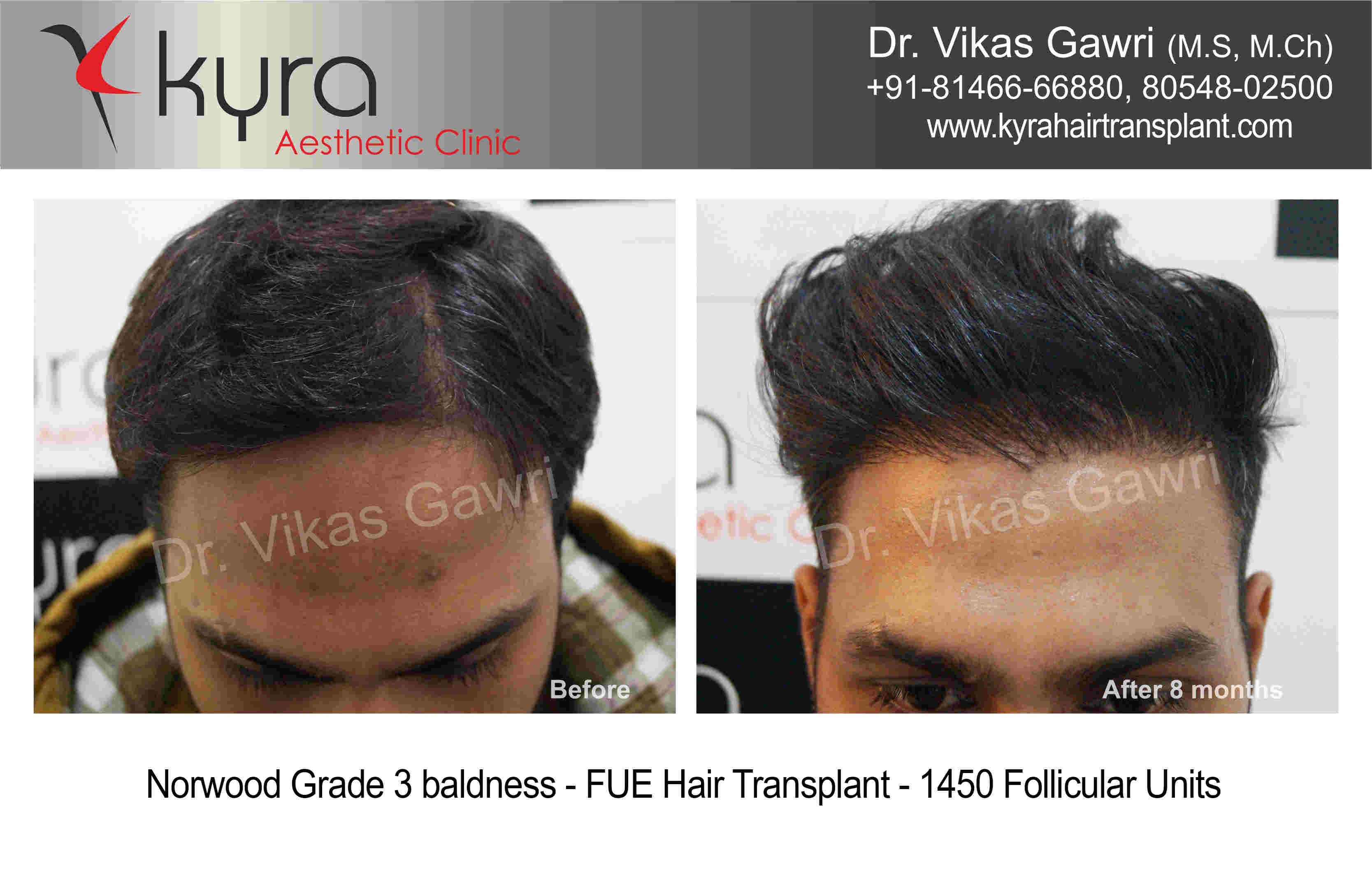 best hair transplant in Punjab  Nova Clinic Chandigarh