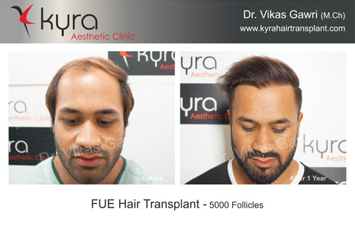 First Choice Hair Transplant  Cosmetics  Ludhiana