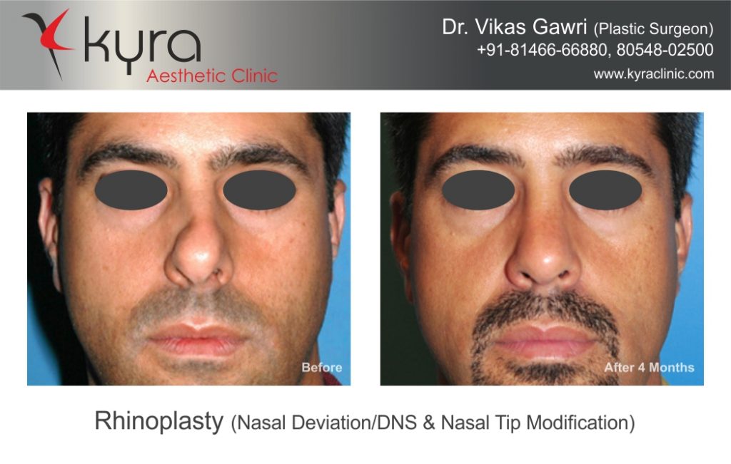 Before & After- Rhinoplasty - Cosmetic Surgery in Ludhiana, Plastic ...