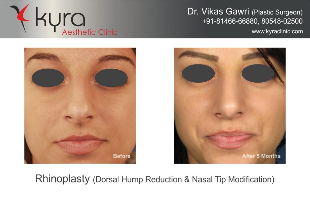 Before & After- Rhinoplasty - Cosmetic Surgery in Ludhiana, Plastic ...
