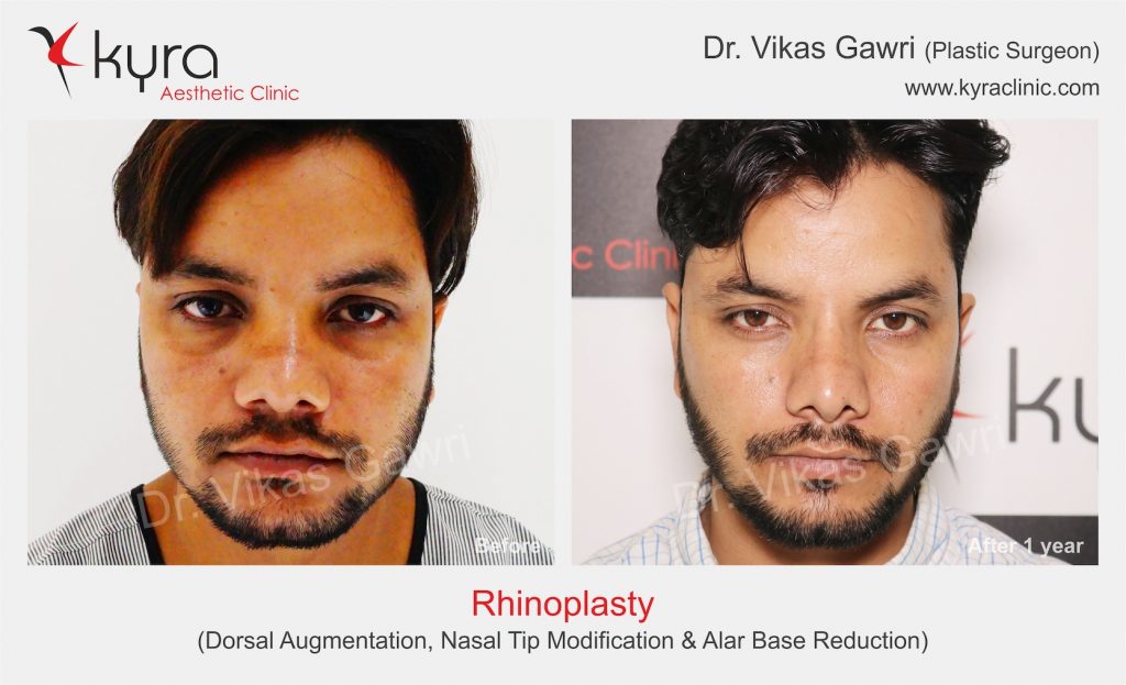 Before & After- Rhinoplasty - Cosmetic Surgery in Ludhiana, Plastic ...