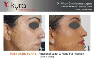 acne-scars-amritpal-kaur-1