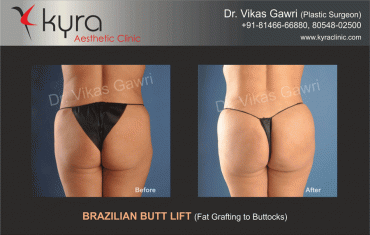 brazilian-butt-lift-1 brazilian-butt-lift-1