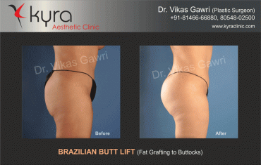 brazilian-butt-lift-2 brazilian-butt-lift-2