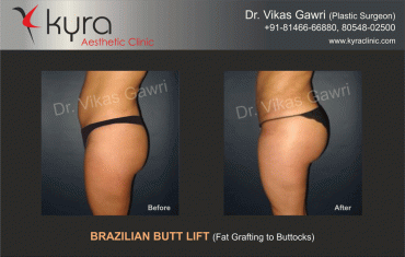 brazilian-butt-lift-3 brazilian-butt-lift-3