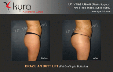 brazilian-butt-lift-4 brazilian-butt-lift-4